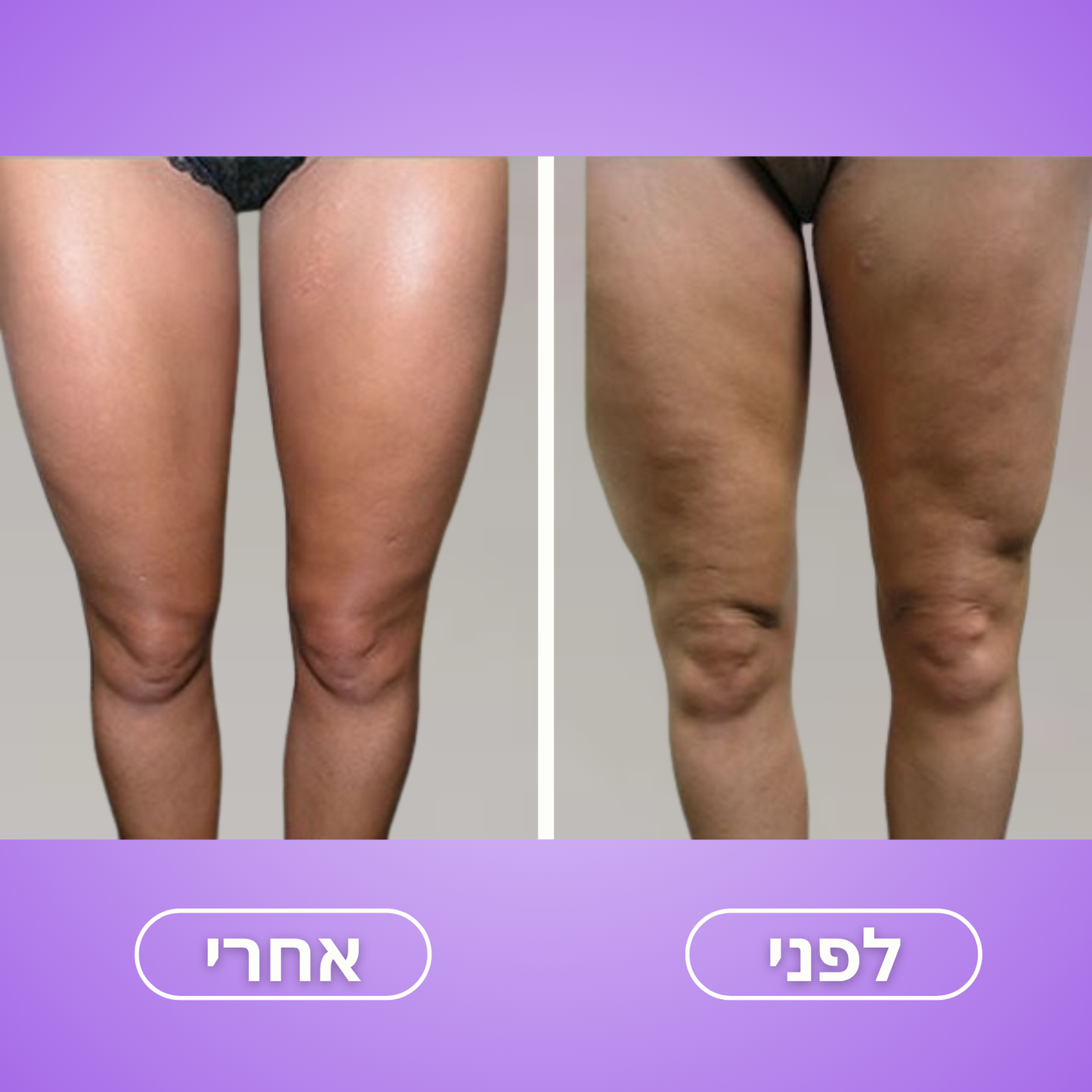 Moodie Smoothy™ – לעיצוב הגוף והפחתת צלוליט