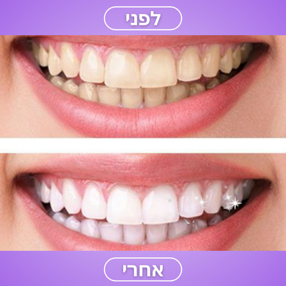 FRESH SMILE™ – מוס להלבנת שיניים בייתית