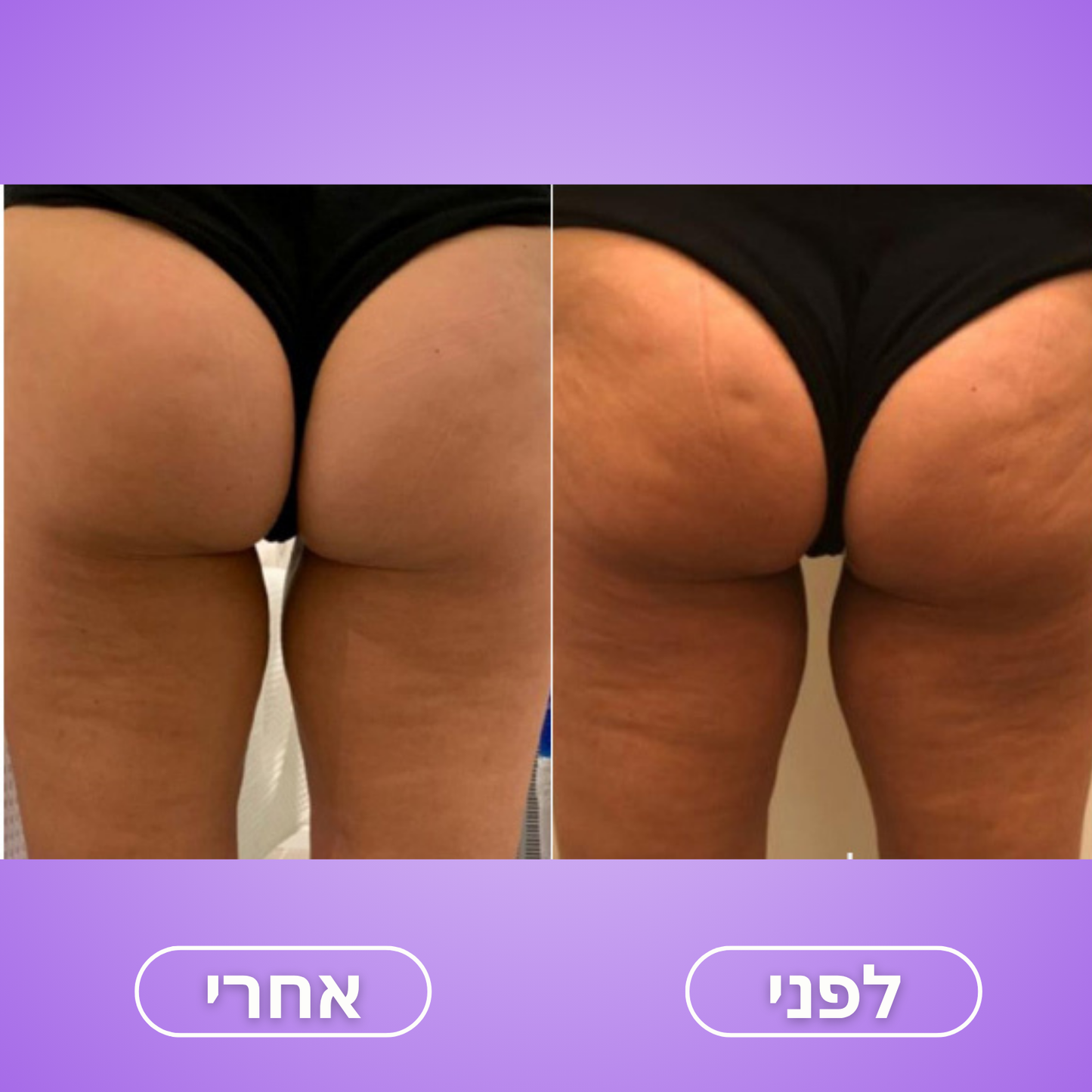 Moodie Smoothy™ – לעיצוב הגוף והפחתת צלוליט