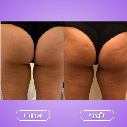 Moodie Smoothy™ – לעיצוב הגוף והפחתת צלוליט